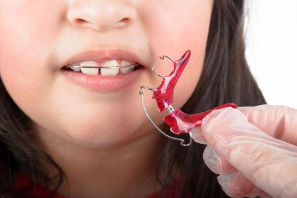 How A Palatal Expander Works