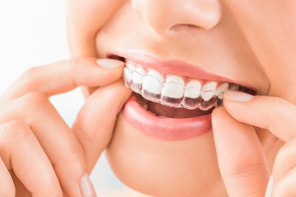 Can Invisalign Be Used For Top And Bottom Teeth?