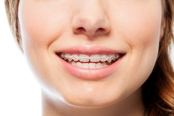 Reasons To Consider Clear Braces For Teens