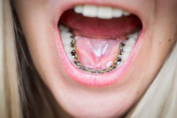 Lingual Braces Are A Discreet Teeth Straightening Treatment