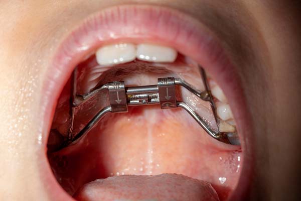 When Is A Palatal Expander Necessary?